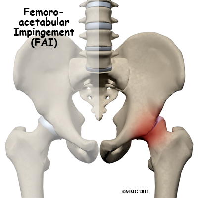 Femoroacetabular Impingement of the Hip