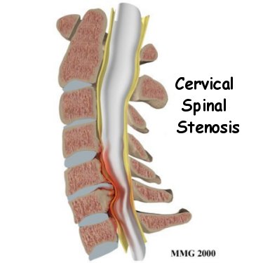 Cervical Spinal Stenosis Guide