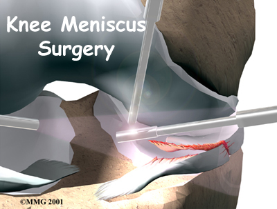 Meniscal Surgery